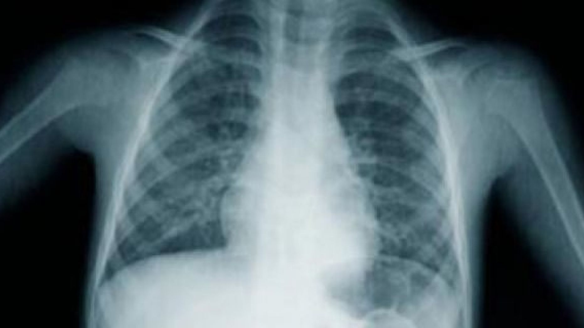 Lung cancer screening most useful in high-risk people